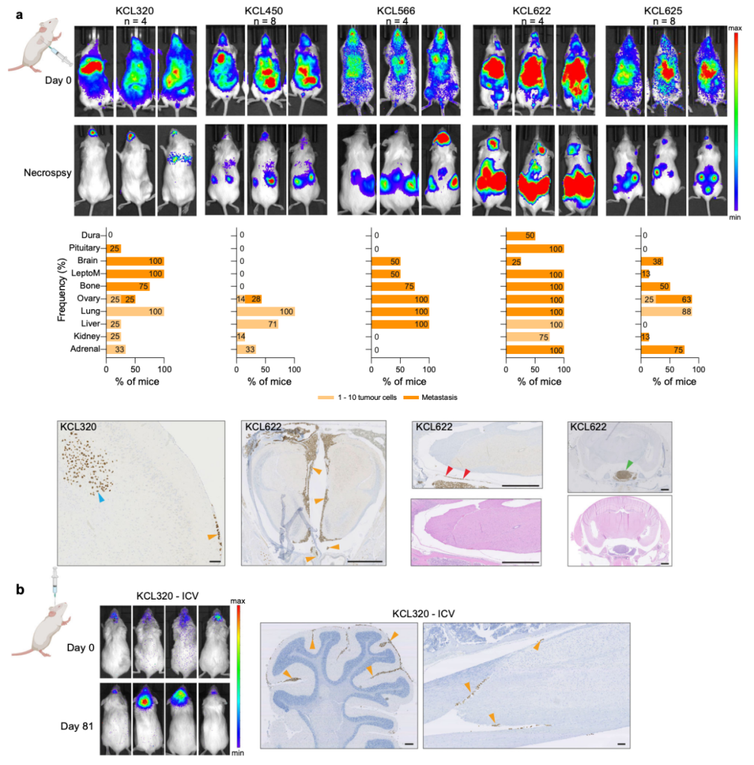Nature子刊：患者來源的類器官，為乳腺癌腦轉移帶來新見解